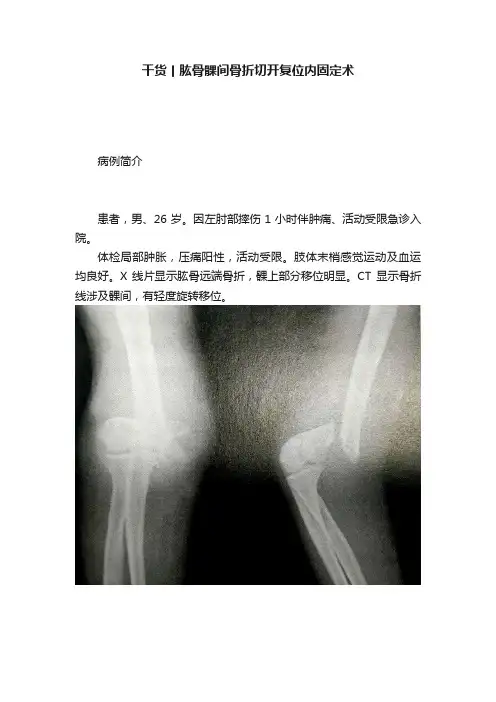 干货丨肱骨髁间骨折切开复位内固定术