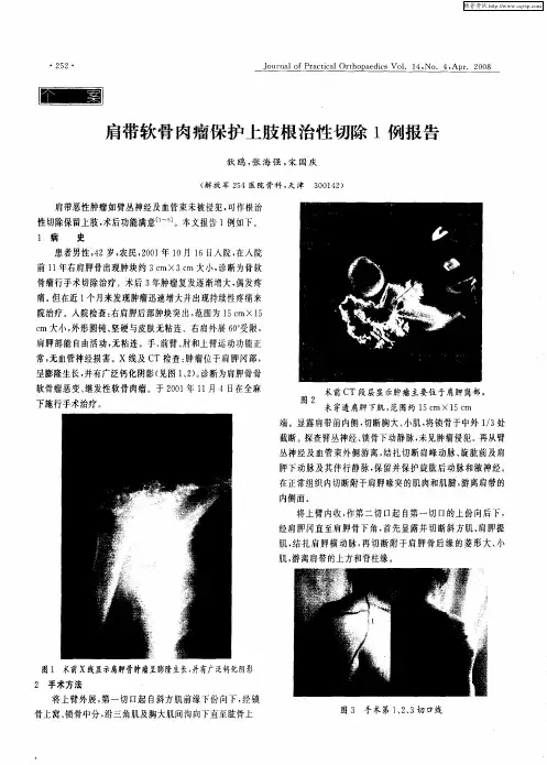 肩带软骨肉瘤保护上肢根治性切除1例报告