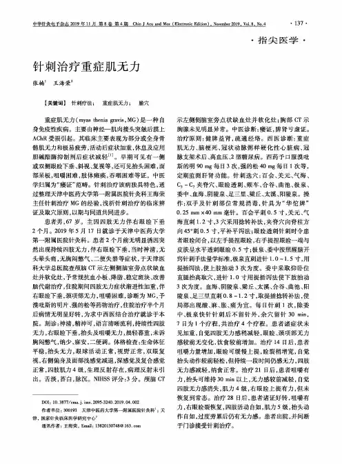 针刺治疗重症肌无力
