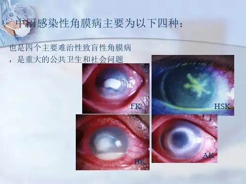 病毒性角膜炎PPT课件