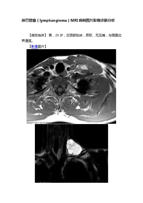 淋巴管瘤（lymphangioma）MRI病例图片影像诊断分析
