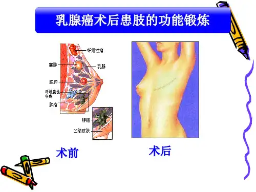 乳腺癌术后的功能锻炼.ppt