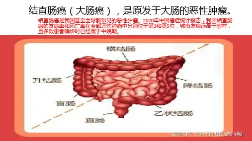 大肠癌PPT