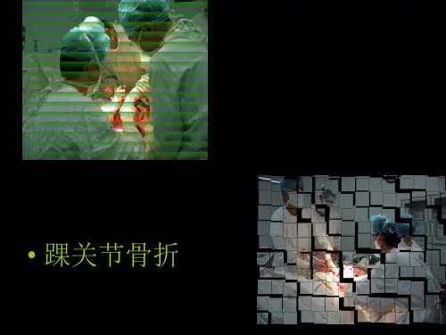 踝关节骨折 ppt课件