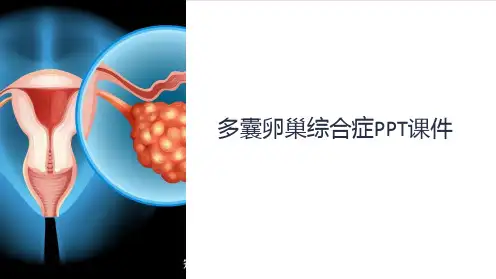 《多囊卵巢综合症》课件