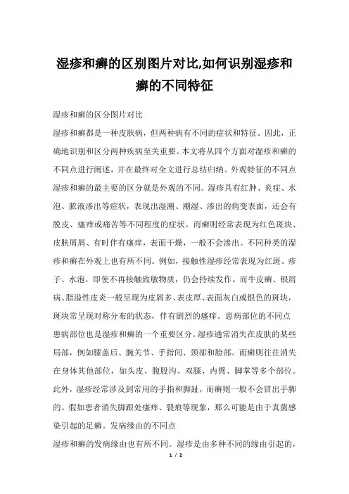 湿疹和癣的区别图片对比,如何识别湿疹和癣的不同特征