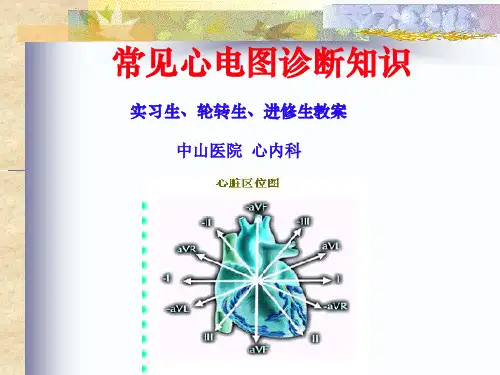 常见心电图诊断