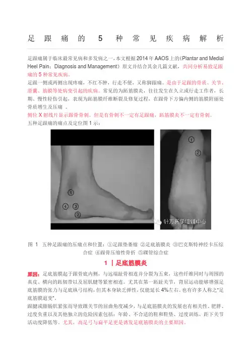 足跟痛的种常见疾病解析