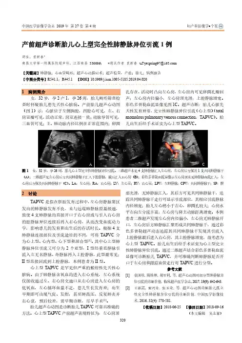 产前超声诊断胎儿心上型完全性肺静脉异位引流1例