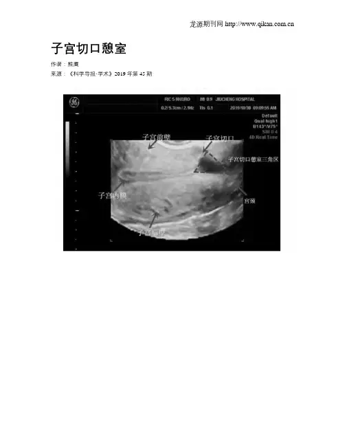 子宫切口憩室