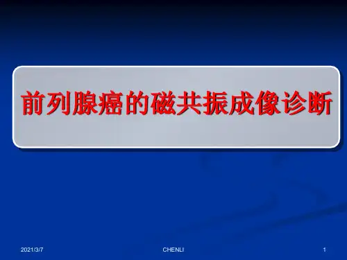 磁共振-前列腺癌-诊断标准