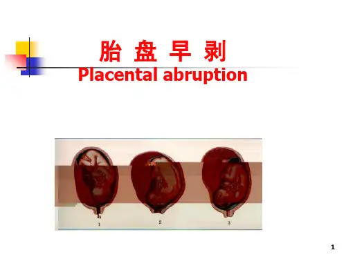 胎盘早剥PPT课件