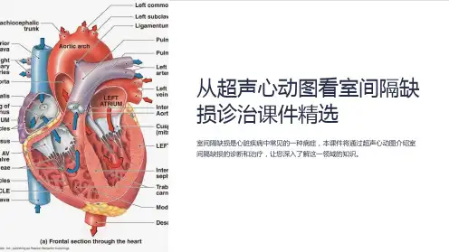 《从超声心动图看室间隔缺损诊治课件》
