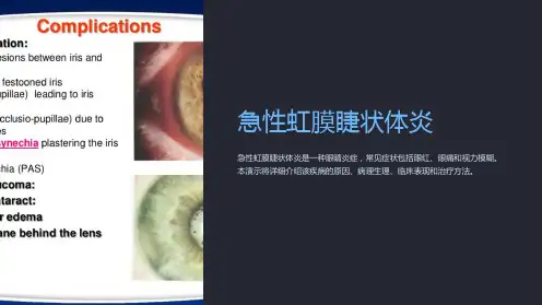 急性虹膜睫状体炎