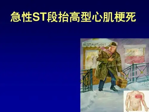 急性ST段抬高型心肌梗死