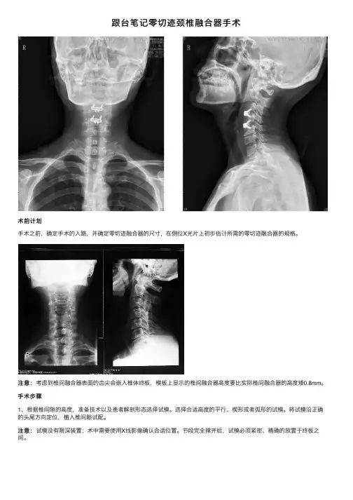 跟台笔记零切迹颈椎融合器手术