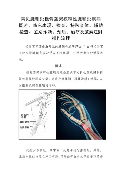 腱鞘炎桡骨茎突狭窄性腱鞘炎概述、临床表现、检查、特殊查体、辅助检查、鉴别诊断、治疗及激素注射操作流程