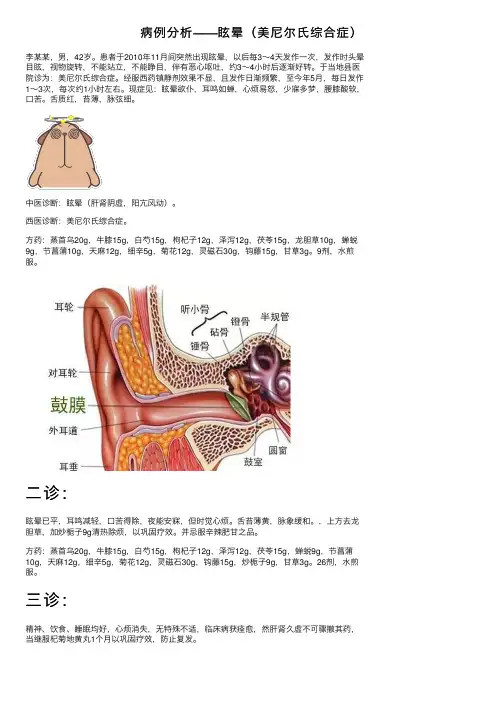 病例分析——眩晕（美尼尔氏综合症）