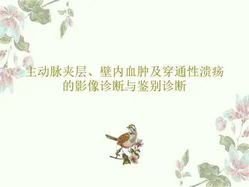 主动脉夹层、壁内血肿及穿通性溃疡的影像诊断与鉴别诊断71页PPT