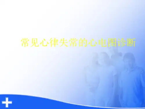常见心律失常的心电图诊断