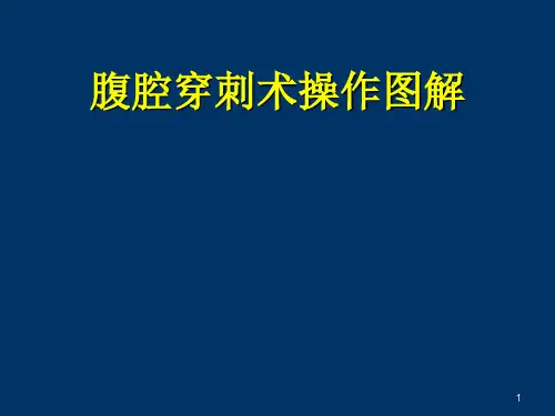 腹腔穿刺术操作图解ppt课件