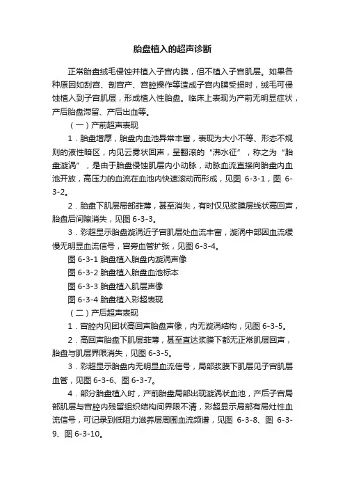 胎盘植入的超声诊断