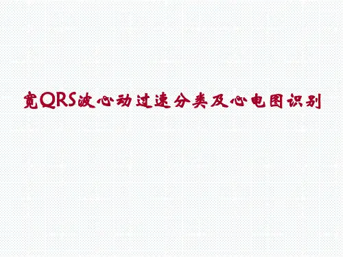 宽QRS波心动过速分类及心电图识别