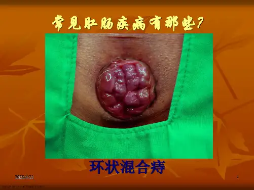 肛肠科科普知识宣讲课件