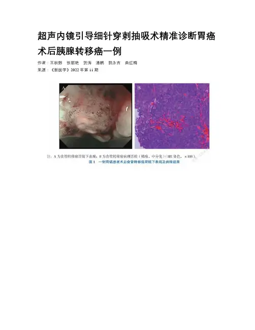 超声内镜引导细针穿刺抽吸术精准诊断胃癌术后胰腺转移癌一例