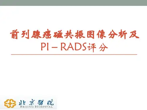 前列腺癌磁共振图像分析及PI-RADS评分