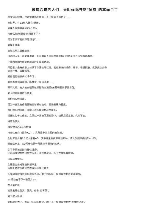 被痒吞噬的人们，是时候揭开这“湿疹”的真面目了