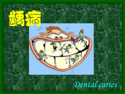 龋病 详解及库