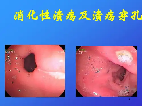 消化性溃疡ppt课件