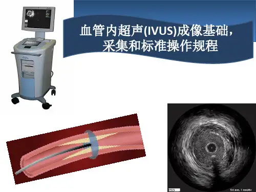 血管内超声IVUS简介