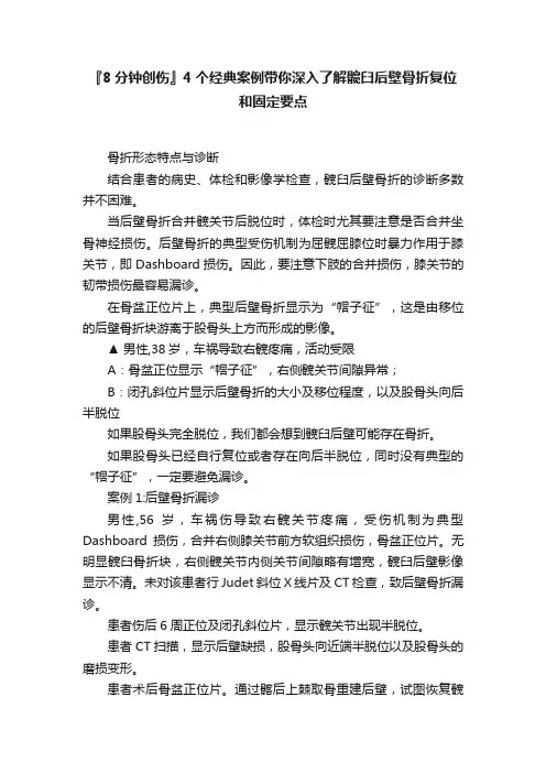 『8分钟创伤』4个经典案例带你深入了解髋臼后壁骨折复位和固定要点