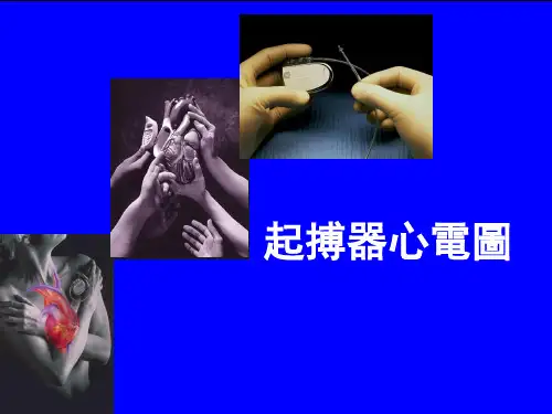 起搏器心电图-起搏器时间间期