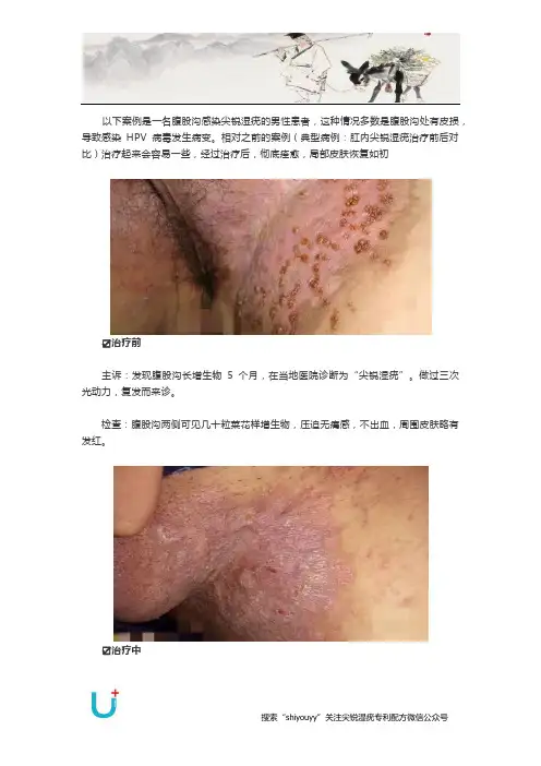 典型病例：腹股沟尖锐湿疣治疗前后对比