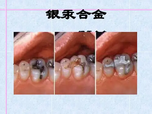 银汞合金