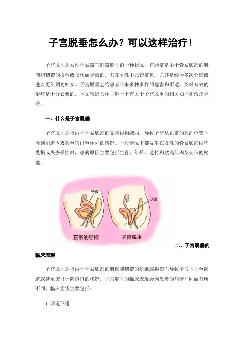 子宫脱垂怎么办？可以这样治疗！