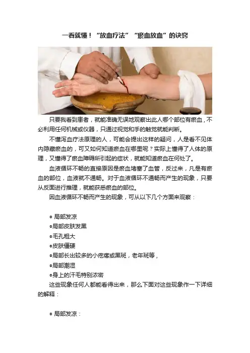 一看就懂！“放血疗法”“瘀血放血”的诀窍