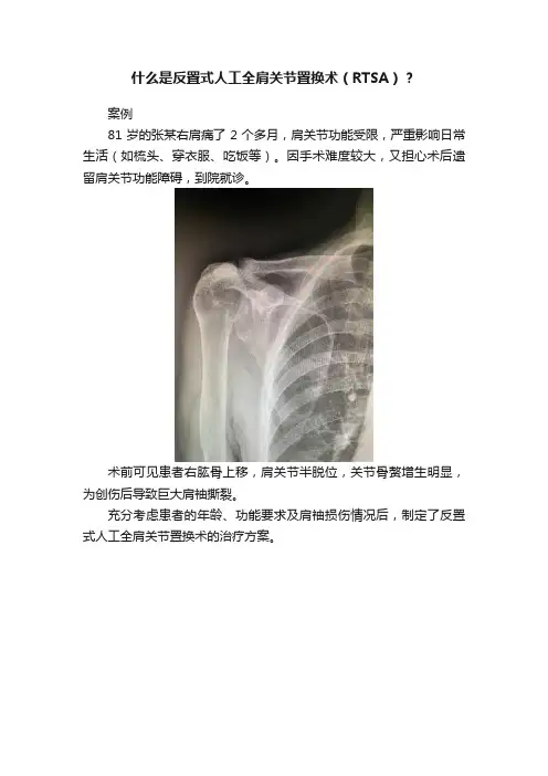 什么是反置式人工全肩关节置换术（RTSA）？