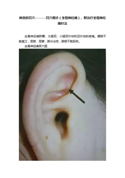 神奇的耳穴--------耳穴视诊（坐骨神经痛）。附治疗坐骨神经痛针法