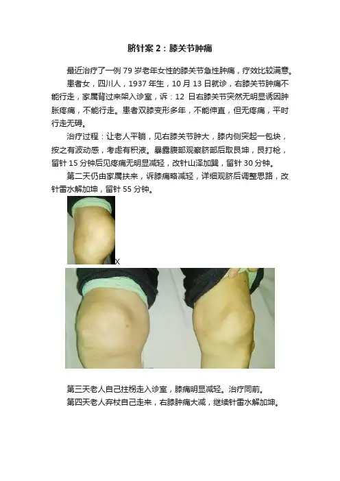 脐针案2：膝关节肿痛