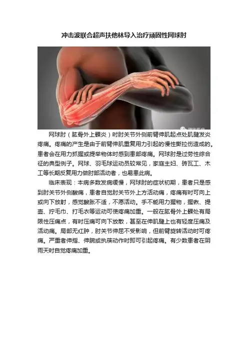 冲击波联合超声扶他林导入治疗顽固性网球肘
