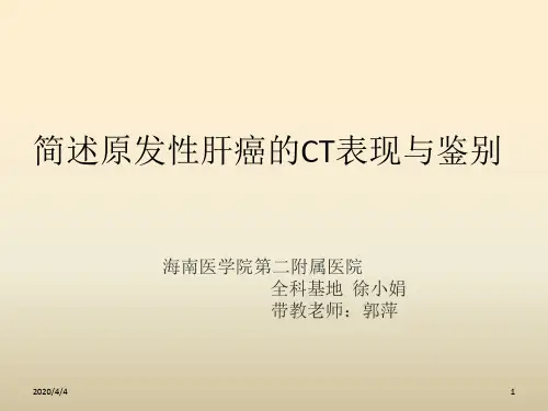 原发性肝癌CT表现与鉴别