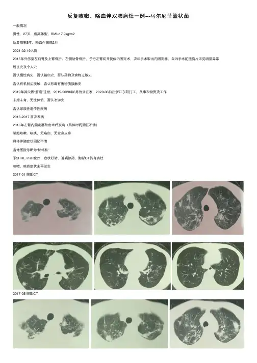 反复咳嗽、咯血伴双肺病灶一例---马尔尼菲篮状菌