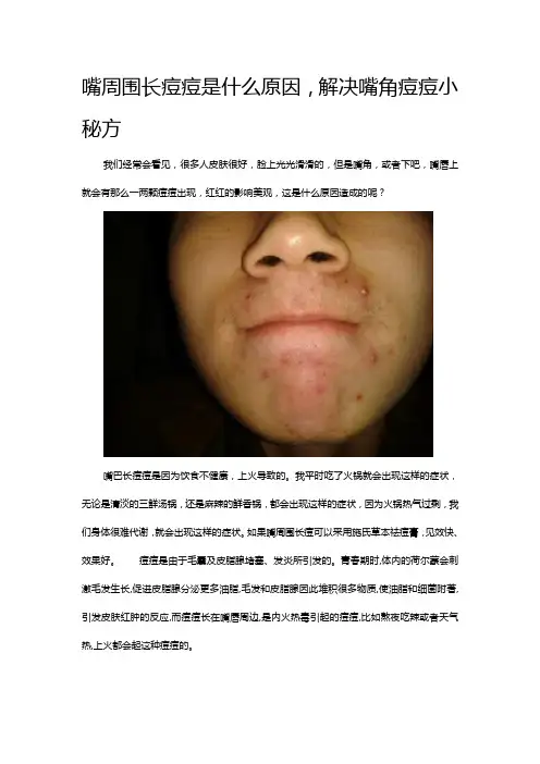 嘴周围长痘痘是什么原因,解决嘴角痘痘小秘方