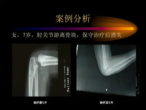 化脓性关节炎PPT课件