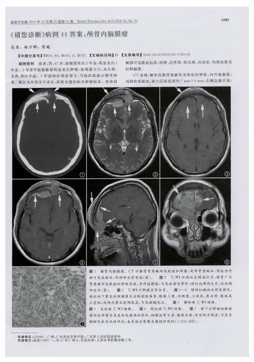 《请您诊断》病例44答案：颅骨内脑膜瘤