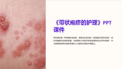 《带状疱疹的护理》课件